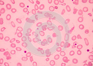 Thalassemia blood smear abnormal red blood cells morphology.