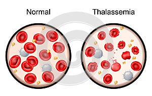 Thalassemia. Close-up of red blood cells