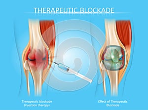 Therapeutic Blockage with Injection Therapy Vector