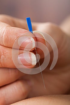 Therapist Performing Acupuncture Treatment