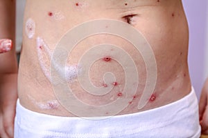 Therapy against the virus of Varicella has measles, chicken pox, rubella