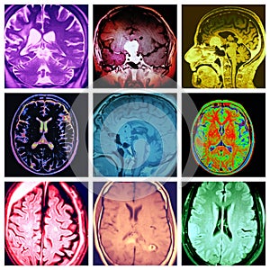 Cerebro diferente patología vistoso 