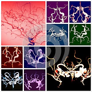 Atherosclerotic brain vessels colorful collage