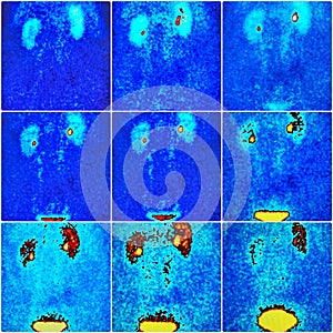 Nuclear renal scan nine images excretion collage