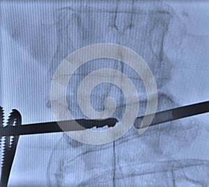 Lumbar pain treatment radiofrequency ablation photo
