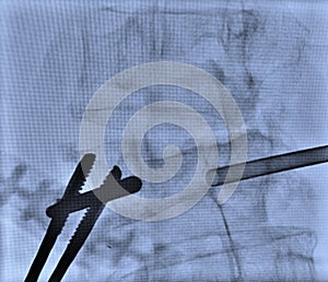 Lumbar pain treatment radiofrequency ablation photo