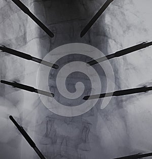 Fluoroscopy radiofrequency ablation lumbar spine
