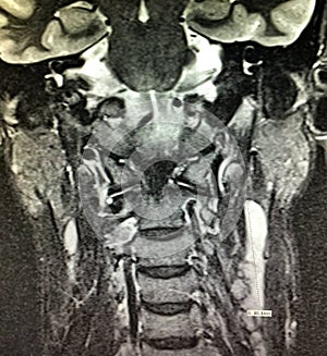 Nasopharyngeal carcinoma mri head neck exam photo