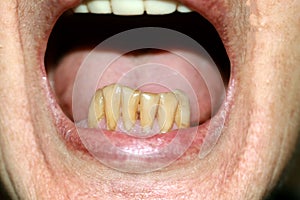 There are no teeth on the sides of the lower jaw. Lower teeth yellow, of different heights. Parodontosis.