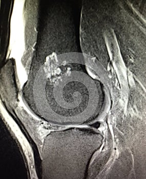 Knee pathology chondroid lesion enchondroma mri photo