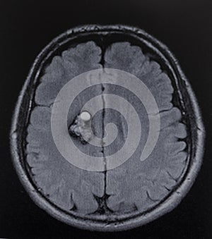 Mri cavernoma ganglia brain exam photo