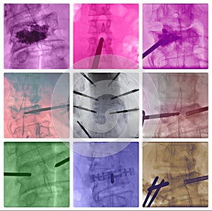 Radiofrequency ablation spinal vertebrae colorful collage