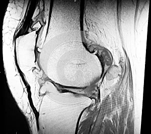 Knee severe osteoarthrosis meniscus pathology mri photo