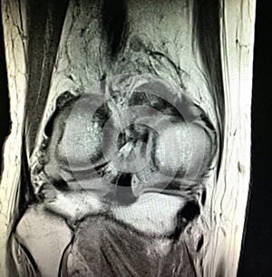 Knee rheumatoid arthritis severe synovitis mri photo