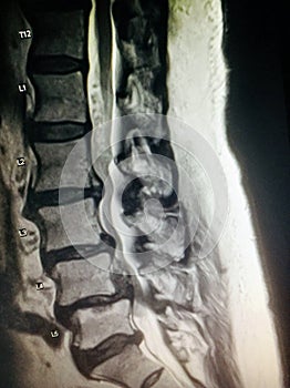 Severe spinal canal stenosis pathology mri exam photo