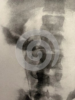 Xray examination abdomen pelvis gunshot war victim