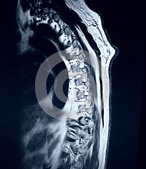 Thoracic vertebrae pathological body compression mri photo