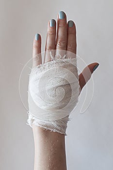 The thermal burn on a female hand covered with a bandage