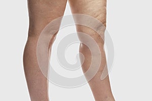 Thick female legs with cellulite and varicose veins. Overweight and disease. Close-up.  on a light gray background