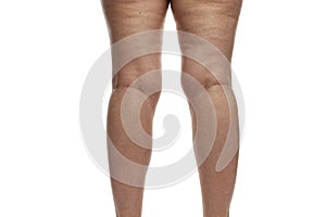 Thick female legs with cellulite and veins. Problems of excess weight and blood vessels. Isolated on white background. Back view