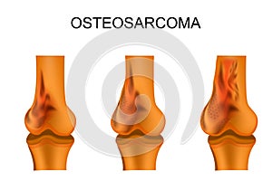 The thigh bone affected by osteosarcoma