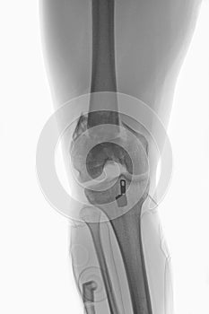 Thighbone fracture