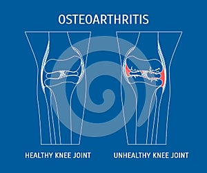 Thin Line Osteoarthritis Healthy and Unhealthy Knee. Vector