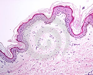 Pigmented thin skin photo