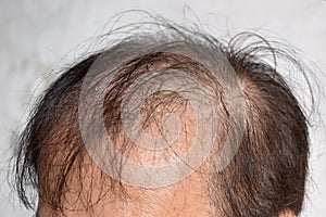 Thinning or sparse hair, male pattern hair loss in Asian elder man