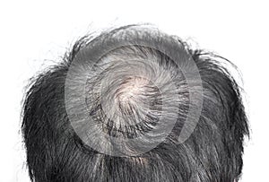 Thinning or sparse hair, male pattern hair loss in Southeast Asian, Chinese elder man