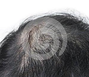 Thinning or sparse hair, male pattern hair loss in Southeast Asian, Chinese elder man