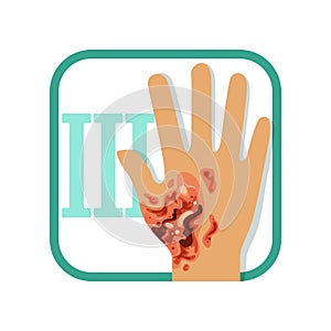 Third degree of burn. Hand with damaged outer epidermis and inner dermis layer of skin. Severe injury. Flat vector