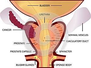 Third stage of prostate cancer. The tumor is big and located in prostate and developed into seminal vesicles