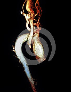 Thoracic aorta aneurism mra photo