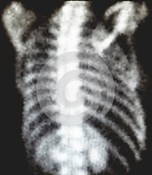 Thoracic nuclear medicine bone scan - normal image