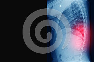 X-ray Thoracic spine fracture radiograph of thoracic and lumbar spine lateral projection, traumatology and orthopedics photo