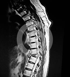 Thoracic vertebrae pathological body compression mri