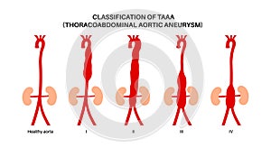 Thoracoabdominal aortic aneurysm