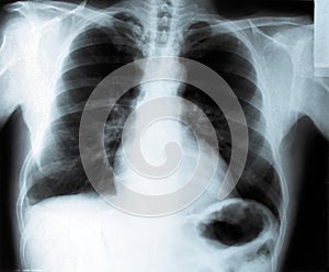 Thorax x-ray