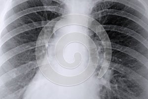 Thorax X-ray of the lungs