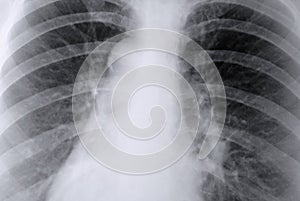 Thorax X-ray of the lungs photo