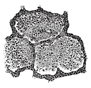 Three alveoli filled with fibrinous exudate, vintage engraving