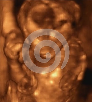 Three Dimensional Ultrasound