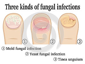 Three kinds of fungal infections