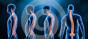 Three main curvatures of the spine disorders or deformities on male body: lordosis, kyphosis and scoliosis 3D rendering photo