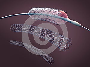 Three metal stents for implantation and supporting blood circulation into blood vessels and catheter