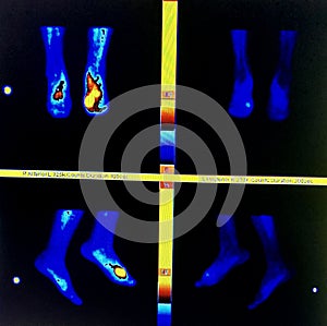 Three phase bone scan active inflammation