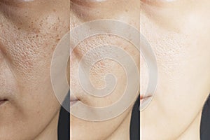 Three pictures compared effect Before and After treatment. skin with problems of freckles , pore , dull skin and wrinkles