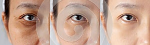 Three pictures compared effect Before and After treatment. under eyes with problems of dark circles ,puffiness and wrinkles