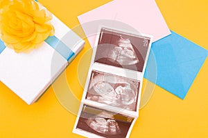 three snapshots of ultrasound on pink and blue envelopes, next to which is a silver box
